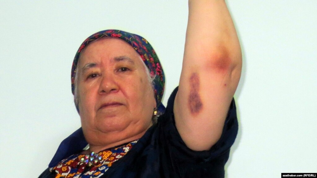 RFE/RL Turkmen Service correspondent Soltan Achilova, showing bruises suffered during a late-October attack in Ashgabat. (RFE/RL).